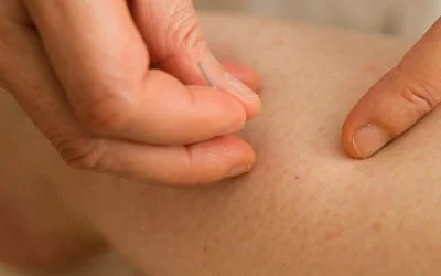 What Are Some Conditions That Can Be Treated with Acupuncture?